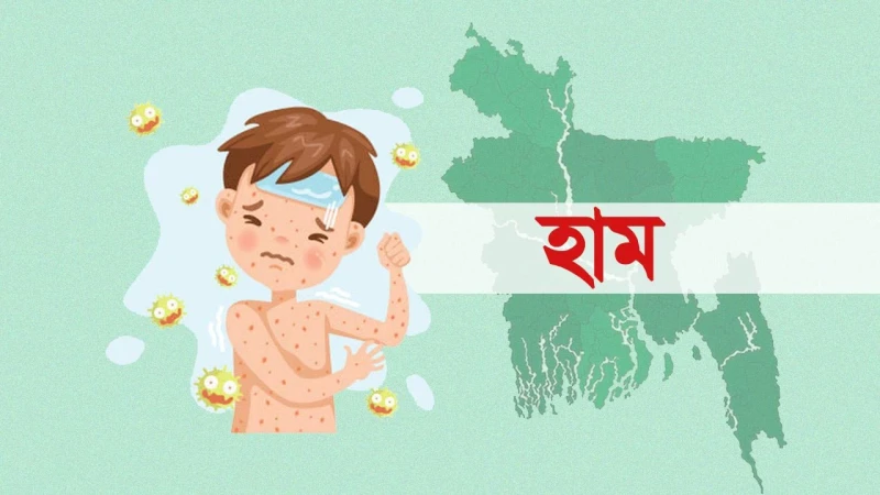 হাম ও উপসর্গে আরও ৯ শিশুর মৃত্যু